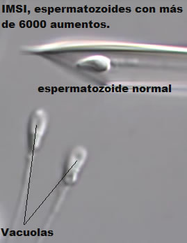 Centro Integral de Reproducción Humana - Microinyección Intracitoplasmática de Esperma Seleccionado Morfológicamente (IMSI)